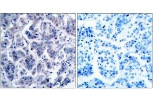 Immunohistochemistry analysis of paraffin-embedded human breast carcinoma tissue, using TYK2 (Ab-1054) Antibody.