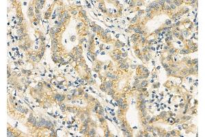ABIN6258794 and ABIN6275896 at 1/100 staining Human colorectal cancer by IHC-P. (FAM3D antibody  (C-Term))
