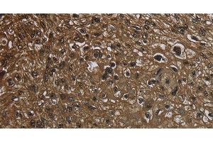 Immunohistochemistry of paraffin-embedded Human esophagus cancer using GLO1 Polyclonal Antibody at dilution of 1:50 (GLO1 antibody)