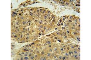 Beta III Tubulin antibody immunohistochemistry analysis in formalin fixed and paraffin embedded human hepatocarcinoma. (TUBB3 antibody  (AA 36-63))
