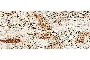 Immunohistochemistry of paraffin-embedded Human esophagus cancer tissue using PAFAH1B2 Polyclonal Antibody at dilution of 1:60(x200) (PAFAH1B2 antibody)