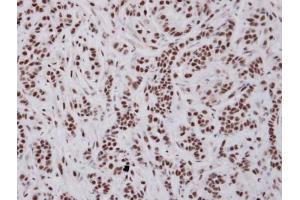 IHC-P Image Immunohistochemical analysis of paraffin-embedded A549 xenograft , using UAP56, antibody at 1:100 dilution.