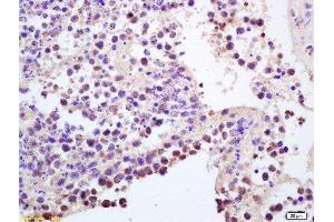 Formalin-fixed and paraffin embedded mouse intestine carcinoma labeled with Anti-CCR5/CD195 Polyclonal Antibody, Unconjugated  at 1:200, followed by conjugation to the secondary antibody and DAB staining (CCR5 antibody  (AA 201-300))