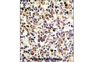 Formalin-fixed and paraffin-embedded human kidney carcinoma with KRT10 Antibody (N-term), which was peroxidase-conjugated to the secondary antibody, followed by DAB staining. (Keratin 10 antibody  (N-Term))
