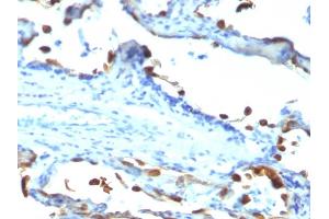 Formalin-fixed, paraffin-embedded human Lung Carcinoma stained with Milk Fat Globule Monoclonal Antibody (EDM45) (MFGE8 antibody)
