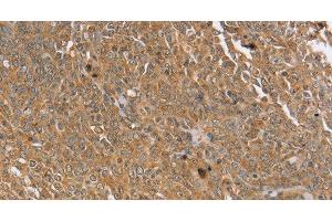 Immunohistochemistry of paraffin-embedded Human cervical cancer using PTPN20 Polyclonal Antibody at dilution of 1:30 (PTPN20 antibody)