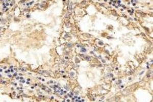 Immunohistochemistry analysis of paraffin-embedded human kidney cancer using TPPP3 (ABIN7076047) at dilution of 1: 3000