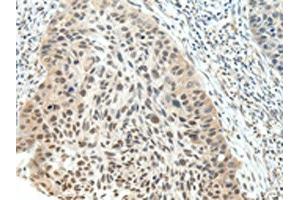 The image on the left is immunohistochemistry of paraffin-embedded Human esophagus cancer tissue using ABIN7191723(NSD1 Antibody) at dilution 1/25, on the right is treated with synthetic peptide. (NSD1 antibody)