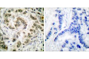 Peptide - +Immunohistochemical analysis of paraffin-embedded human lung carcinoma tissue usingantibody (#C0178). (E2F4 antibody)