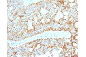 IHC testing of FFPE human colon carcinoma with MAML2 antibody (clone MMLP2-1). (MAML2 antibody)