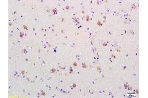 Formalin-fixed and paraffin embedded human brain glioblastoma labeled Anti-PDCD4 Polyclonal Antibody, Unconjugated (ABIN731993) at 1:200, followed by conjugation to the secondary antibody and DAB staining