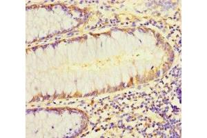 Immunohistochemistry of paraffin-embedded human colon cancer using ABIN7158401 at dilution of 1:100 (L1TD1 antibody  (AA 665-865))
