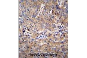 DEF Antibody (N-term) (ABIN655755 and ABIN2845199) immunohistochemistry analysis in formalin fixed and paraffin embedded human hepatocarcinoma followed by peroxidase conjugation of the secondary antibody and DAB staining. (ZC3H18 antibody  (N-Term))