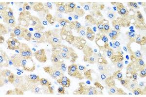 Immunohistochemistry of paraffin-embedded Human liver damage using SNAP29 Polyclonal Antibody at dilution of 1:100 (40x lens). (SNAP29 antibody)