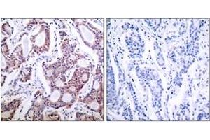 Immunohistochemistry analysis of paraffin-embedded human breast carcinoma tissue, using NF-kappaB p100/p52 (Ab-869) Antibody. (NFKB2 antibody  (AA 836-885))