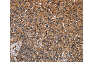 Immunohistochemistry of Human lung cancer using GH2 Polyclonal Antibody at dilution of 1:40 (Growth Hormone 2 antibody)