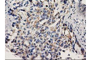Immunohistochemical staining of paraffin-embedded Carcinoma of Human lung tissue using anti-NDEL1 mouse monoclonal antibody.