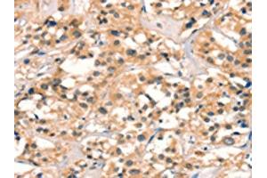 The image on the left is immunohistochemistry of paraffin-embedded Human thyroid cancer tissue using ABIN7129096(CUEDC2 Antibody) at dilution 1/30, on the right is treated with fusion protein.