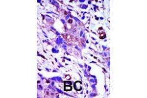Formalin-fixed and paraffin-embedded human cancer tissue reacted with the primary antibody, which was peroxidase-conjugated to the secondary antibody, followed by AEC staining. (PLK1 antibody  (C-Term))