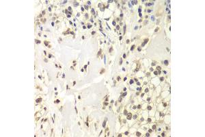 Immunohistochemistry of paraffin-embedded human kidney cancer using USP7 antibody (ABIN6293331) at dilution of 1:200 (40x lens).