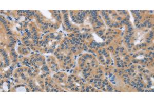Immunohistochemistry of paraffin-embedded Human thyroid cancer using HSD3B1 Polyclonal Antibody at dilution of 1:40 (HSD3B1 antibody)