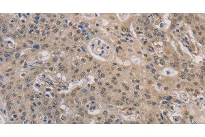 Immunohistochemistry of paraffin-embedded Human gastric cancer using DPYSL3 Polyclonal Antibody at dilution of 1:30 (DPYSL3 antibody)
