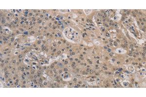 Immunohistochemistry of paraffin-embedded Human gastric cancer using DPYSL3 Polyclonal Antibody at dilution of 1:30