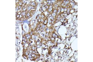 Immunohistochemistry of paraffin-embedded human colon carcinoma using N-WASP/WASL antibody (ABIN3016273, ABIN3016274, ABIN3016275, ABIN1683282 and ABIN6219682) at dilution of 1:100 (40x lens).