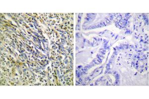 Cl-Peptide - +Immunohistochemical analysis of paraffin-embedded human lung carcinoma tissue using Aggrecan (Cleaved-Asp369) antibody (#L0101). (Aggrecan antibody  (Cleaved-Asp369))