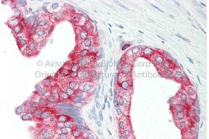 Rabbit Anti-KRT8 Antibody Catalog Number: ARP66386 Formalin Fixed Paraffin Embedded Tissue: Human Adult Prostate  Observed Staining: Cytoplasm in hepatocytes Primary Antibody Concentration: 1:600 Secondary Antibody: Donkey anti-Rabbit-Cy3 Secondary Antibody Concentration: 1:200 Magnification: 20X Exposure Time: 0.