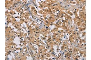 The image on the left is immunohistochemistry of paraffin-embedded Human thyroid cancer tissue using ABIN7129183(DDX43 Antibody) at dilution 1/50, on the right is treated with fusion protein. (DDX43 antibody)