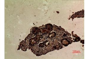 Immunohistochemistry (IHC) analysis of paraffin-embedded Human Prostate Cancer, antibody was diluted at 1:100. (LCP2 antibody  (Internal Region))