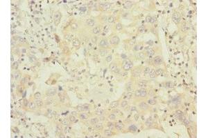 Immunohistochemistry of paraffin-embedded human liver cancer using ABIN7155913 at dilution of 1:100 (HCFC1R1 antibody  (AA 1-119))