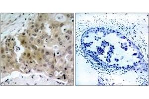 Immunohistochemistry analysis of paraffin-embedded human breast carcinoma, using VEGFR2 (Phospho-Tyr1175) Antibody.