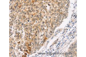 Immunohistochemistry of Human lung cancer using MAPK9 Polyclonal Antibody at dilution of 1:30 (JNK2 antibody)
