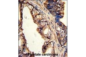 Formalin-fixed and paraffin-embedded human prostate carcinoma with TGM4 Antibody (Center), which was peroxidase-conjugated to the secondary antibody, followed by DAB staining. (TGM4 antibody  (AA 135-164))