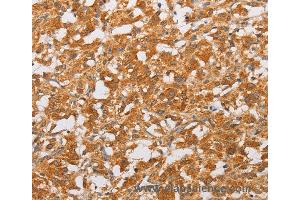 Immunohistochemistry of Human liver cancer using OLR1 Polyclonal Antibody at dilution of 1:50