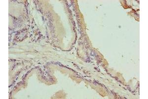 Immunohistochemistry of paraffin-embedded human prostate cancer using ABIN7174755 at dilution of 1:100