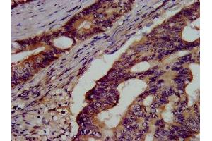 IHC image of ABIN7154126 diluted at 1:500 and staining in paraffin-embedded human colon cancer performed on a Leica BondTM system. (Glutathione Synthetase antibody  (AA 290-418))