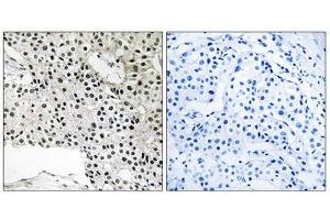 Immunohistochemistry analysis of paraffin-embedded human breast carcinoma tissue using TCEAL4 antibody. (TCEAL4 antibody  (C-Term))