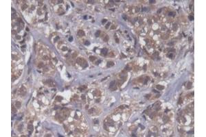 DAB staining on IHC-P; Samples: Human Breast cancer Tissue (UQCRB antibody  (AA 2-111))