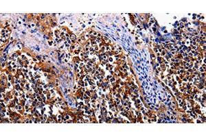 Immunohistochemistry of paraffin-embedded Human tosil tissue using IL17RC Polyclonal Antibody at dilution 1:30 (IL17RC antibody)
