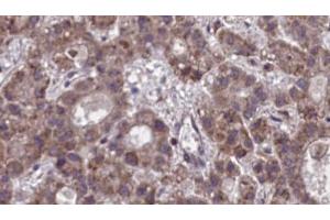 ABIN6273890 at 1/100 staining Human liver cancer tissue by IHC-P. (NPBWR1 antibody  (C-Term))
