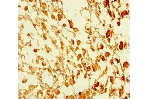 Immunohistochemistry of paraffin-embedded human melanoma using ABIN7172553 at dilution of 1:100 (GATA6 antibody  (AA 496-595))
