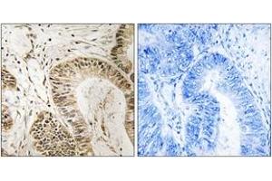 Immunohistochemistry analysis of paraffin-embedded human colon carcinoma tissue, using RGS1 Antibody. (RGS1 antibody  (AA 118-167))