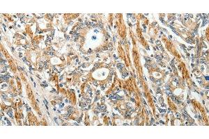 Immunohistochemistry of paraffin-embedded Human gastric cancer using E-Selectin Polyclonal Antibody at dilution of 1:40 (Selectin E/CD62e antibody)