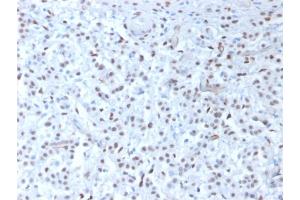 Formalin-fixed, paraffin-embedded human Mesothelioma stained with Wilm's Tumor Mouse Recombinant Monoclonal Antibody (rWT1/857). (Recombinant WT1 antibody)