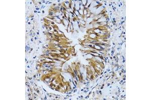 Immunohistochemistry of paraffin-embedded human lung cancer using IMPA1 antibody. (IMPA1 antibody  (AA 1-277))