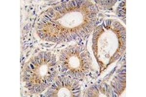 IHC analysis of FFPE human colon carcinoma tissue stained with FGF1 antibody (FGF1 antibody  (AA 5-30))