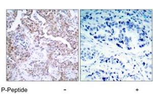Immunohistochemical analysis of paraffin-embedded human breast carcinoma tissue using TP53 (phospho S15) polyclonal antibody . (p53 antibody  (pSer15))